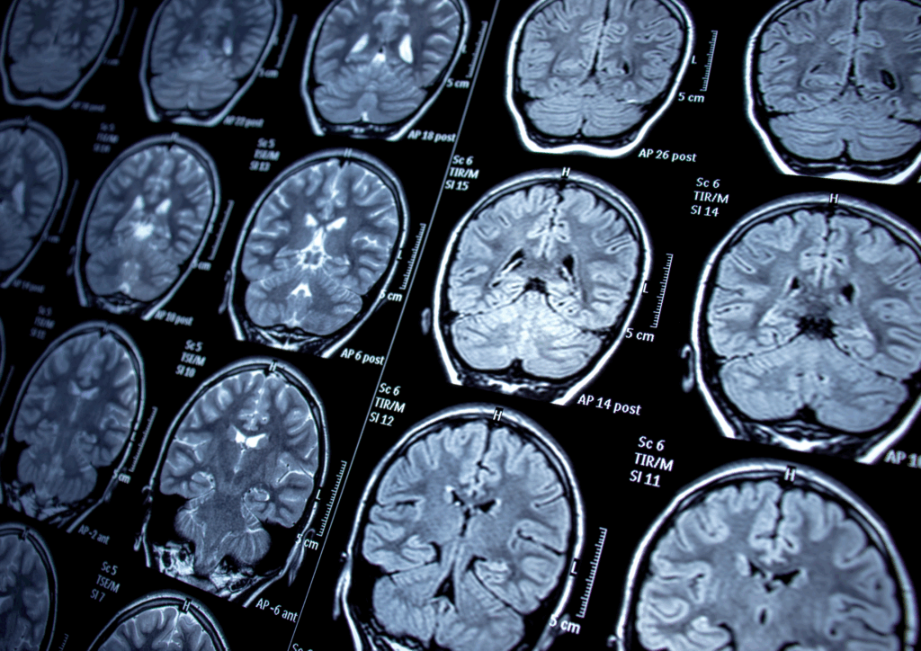 epilepsy